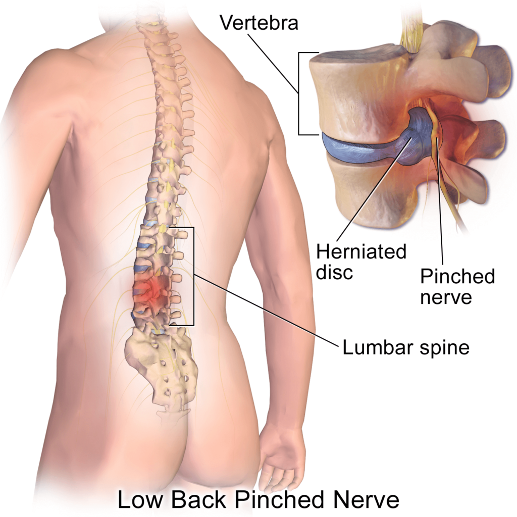 Pinched nerve